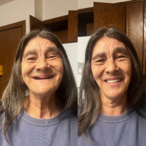 BQYOOM™ DentoFuse Dentures
