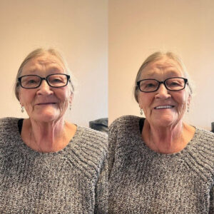 BQYOOM™ DentoFuse Dentures