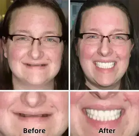 SmileFitPro™–Advanced Custom-Fit Functional Dentures