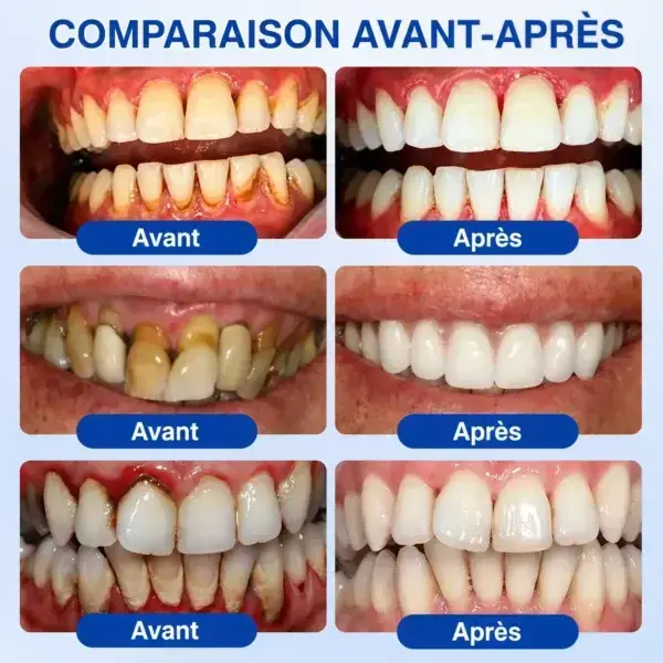 Gel Régénération Parodontale