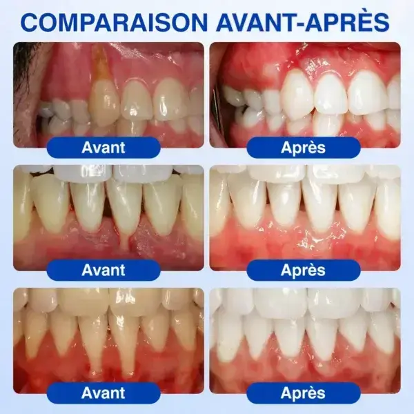 Gel Régénération Parodontale