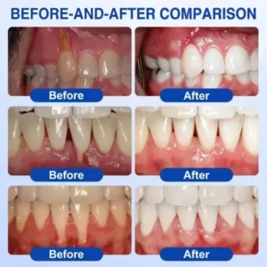 SOLAROZA® GumRevive Periodontal Repair Gel